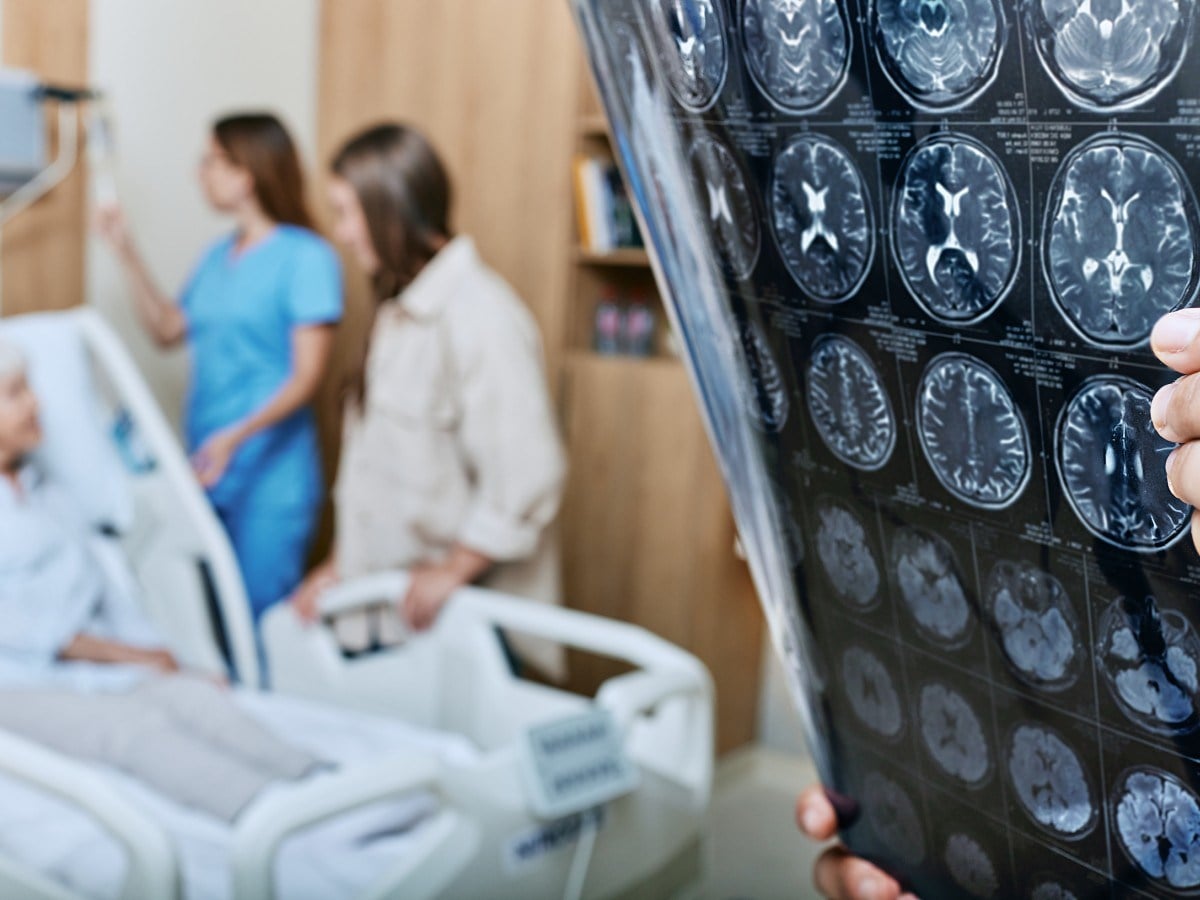 Stroke Rates Are Rising in Young Adults—Experts Reveal How To Cut Risk - Newsweek