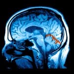 Retatrutide Cuts Sleep Apnea Interruptions in Phase 3 Trials